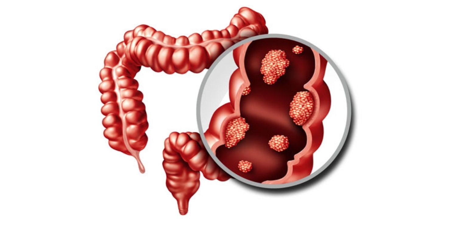 Ứng dụng y tế của natri sunfat