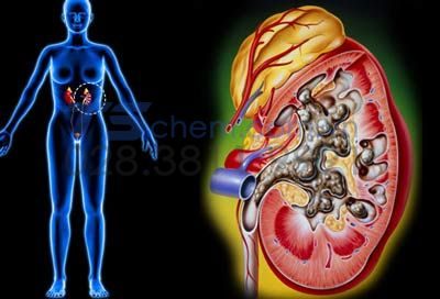 Tác hại của nước cứng đối với sức khỏe con người.