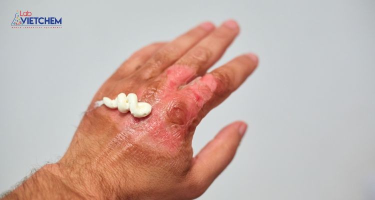 Nồng độ axit propionic cao có thể gây bỏng hóa chất