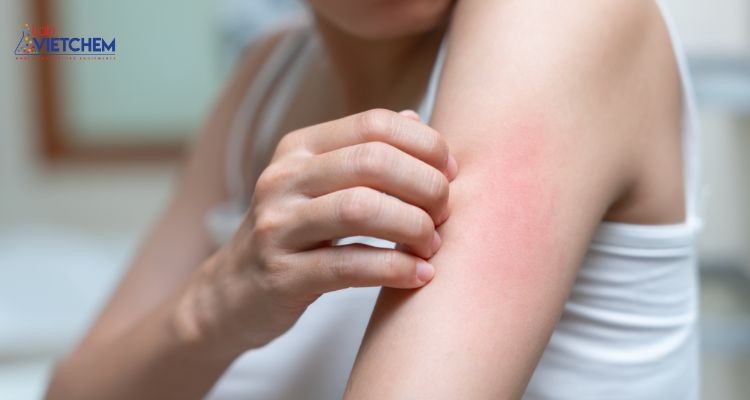 Mỹ phẩm chứa cồn benzyl có thể gây kích ứng da