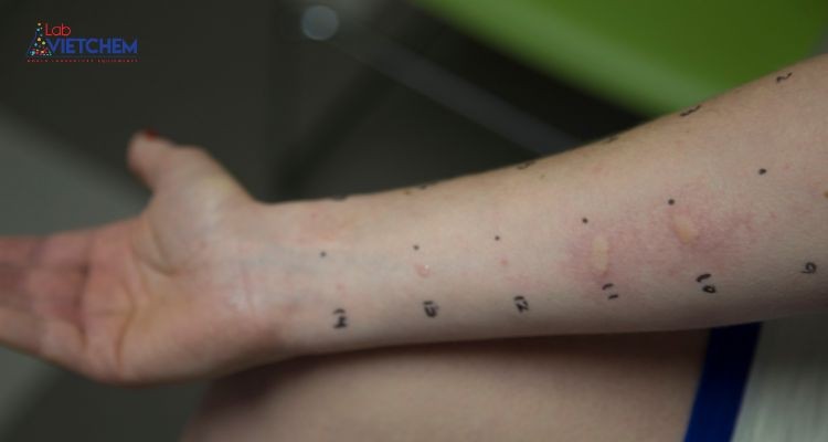 Laureth-7 có thể gây kích ứng da