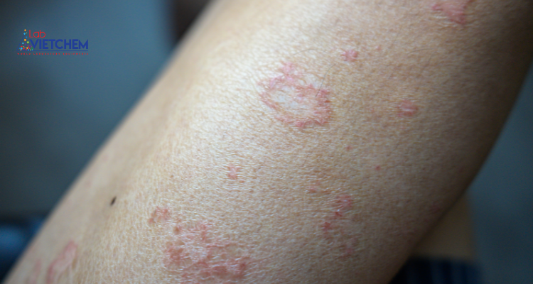 Tiếp xúc với Canxi hypochlorite có thể gây kích ứng da