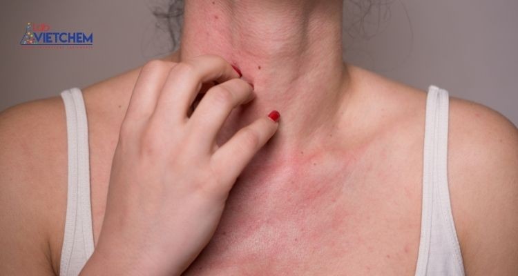 Paraben có thể gây dị ứng ở người có làn da nhạy cảm