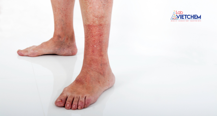 Triệu chứng bỏng