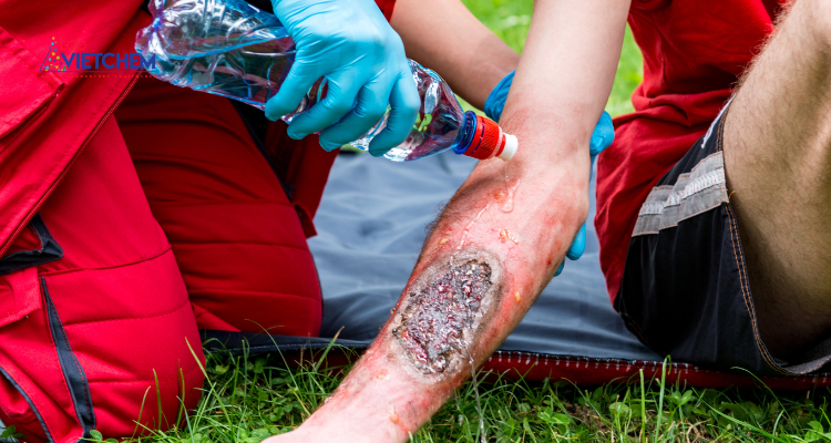 Cách sơ cứu bỏng hóa chất 