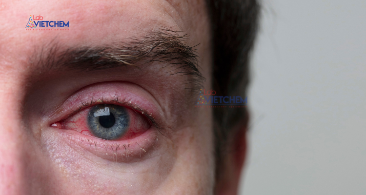 Gây đỏ mắt khi tiếp xúc với nước lâu ngày