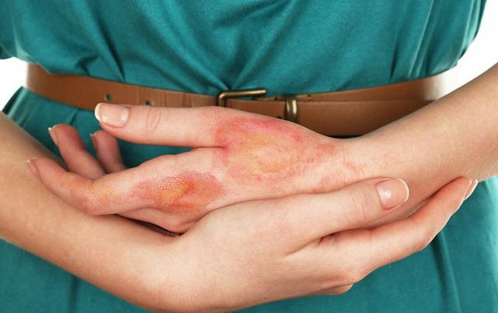 Da sẽ bị bỏng và gan, phổi sẽ bị tổn thương nếu da tiếp xúc với crezol nồng độ cao