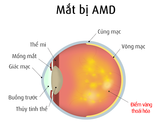 Thoái hóa điểm vàng là do tiếp xúc quá nhiều với ánh sáng xanh
