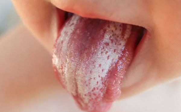 Candida phát triển trong khoang miệng
