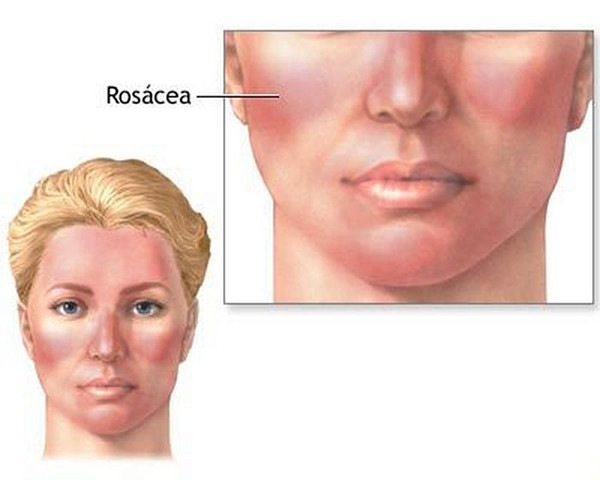 Nồng độ axit clohydric trong dạ dày thấp có thể dẫn đến bệnh rosacea