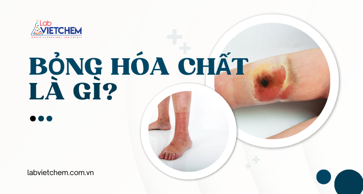 Bỏng hóa chất là gì?