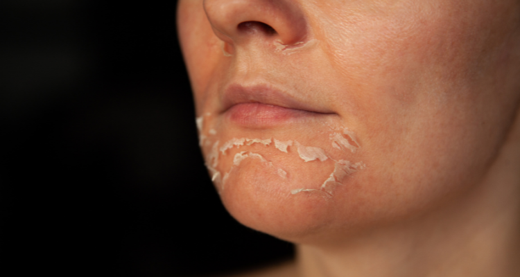 Dùng quá nhiều có thể gây bong tróc da