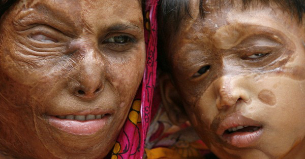 Hậu quả khó lường của bỏng axit